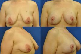 Breast Lift S306
