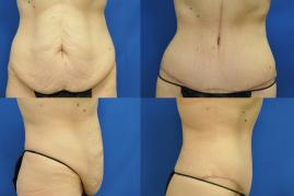 Tummy tuck S307