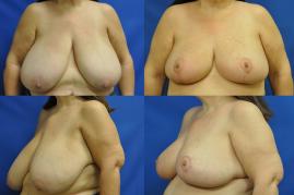 Breast Reduction S309
