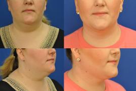 Smart Liposuction of submental area S310