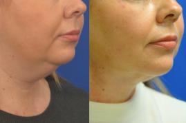 Smart liposuction of the chin S311