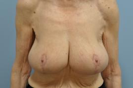 Bilateral Breast Reduction