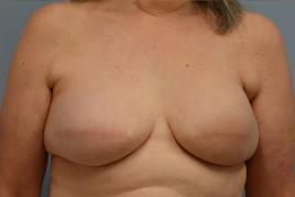 Bilateral Breast Reconstruction