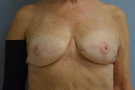 Bilateral Breast Reconstruction