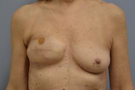 Right expander exchange to permanent implant, revision right reconstructed breast, and Left mastopexy/augmentation for symmetry