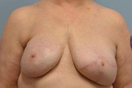 Bilateral Breast Reconstruction