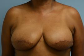 Bilateral Breast Reconstruction