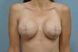 Bilateral Breast Reconstruction