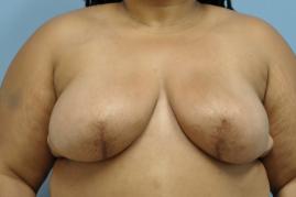 Bilateral Breast Reconstruction