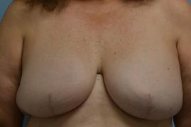 Bilateral Breast Reconstruction