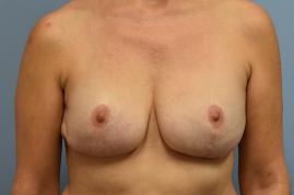 Bilateral Breast Reconstruction