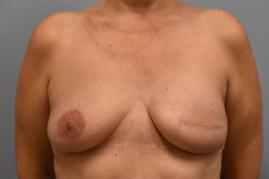 Left breast expander exchange for implant, Left revision of reconstructed breast, Right mastopexy for symmetry