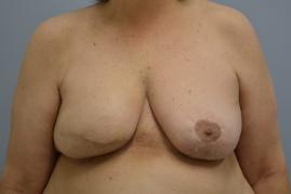 Right Breast Reconstruction