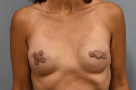 Bilateral Breast Reconstruction