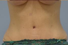 Abdominoplasty