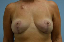 Oncoplastic Reduction