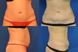 Tummy Tuck S308