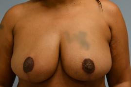 Breast Reduction