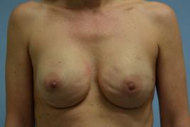 Breast reconstruction with tissue expander