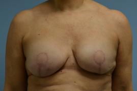 Breast reconstruction with tissue expander