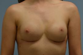 Breast reconstruction with tissue expander