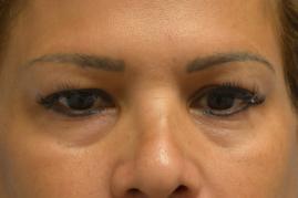 Upper Blepharoplasty, Ptosis Repair, Brow Lift
