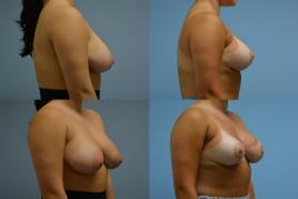 Breast Reduction