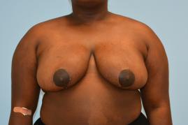 Breast Reduction
