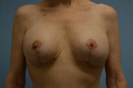 Breast Augmentation and Lift