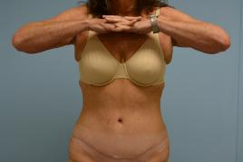 Lipo Abdominoplasty