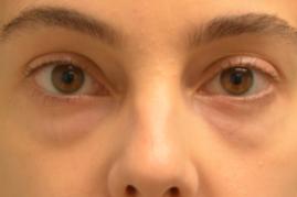 Lower Blepharoplasty