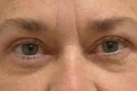 Upper Blepharoplasty
