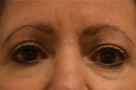 Eyelid Surgery
