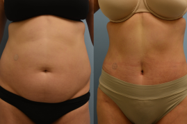 Tummy Tuck