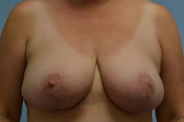 Breast Reduction