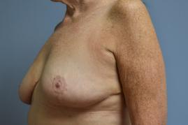 Breast Reduction