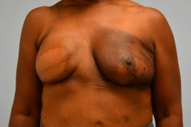 Oncoplastic Reduction