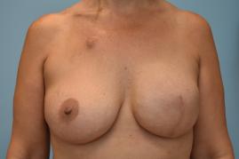 Breast Reconstruction