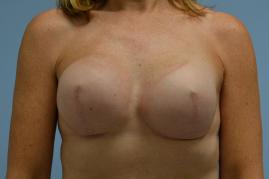 Breast Reconstruction
