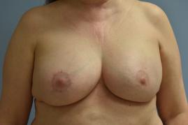 Breast Reconstruction