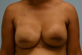 Breast Reconstruction