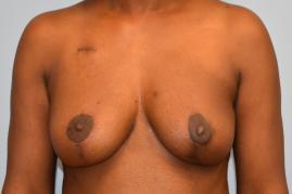 ONCOPLASTIC BREAST REDUCTION