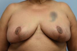 ONCOPLASTIC BREAST REDUCTION