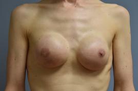 BREAST RECONSTRUCTION WITH TISSUE EXPANDER AND ADM GRAFT