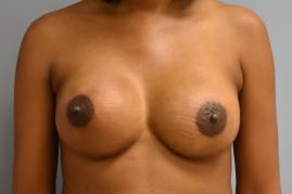 BILATERAL BREAST RECONSTRUCTION WITH TISSUE EXPANDER AND ADM GRAFT