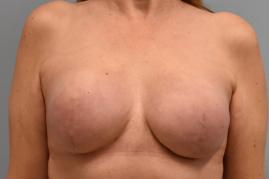 BREAST RECONSTRUCTION WITH TISSUE EXPANDERS 