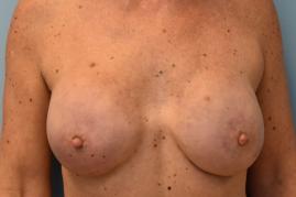 BREAST RECONSTRUCTION WITH TISSUE EXPANDERS 