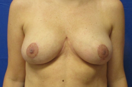 breast reduction before and after