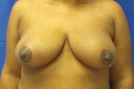 breast reduction before and after