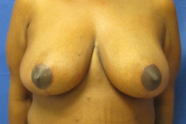 breast reduction before and after